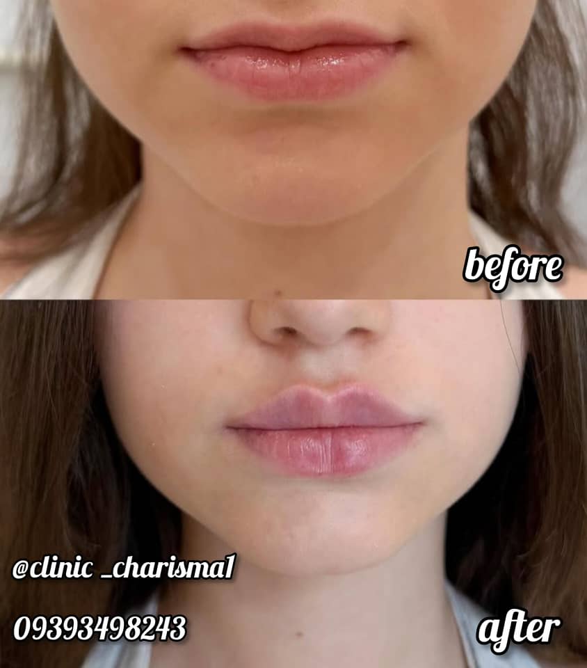 هایفوتراپی